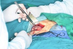 Ethicon Physiomesh Hernia Mesh Product Liability Lawsuits for Injuries and Revision Surgeries